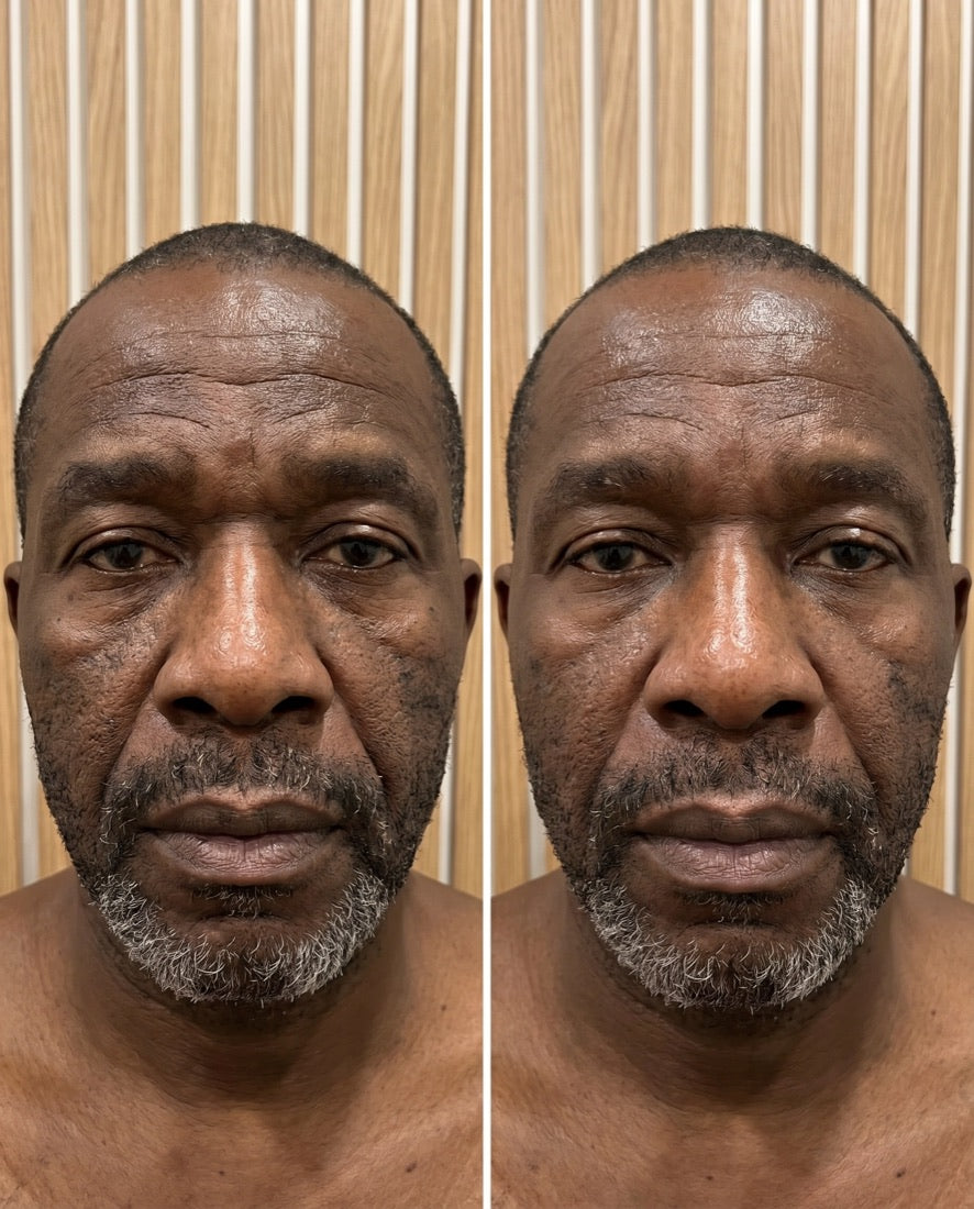 Under eye
